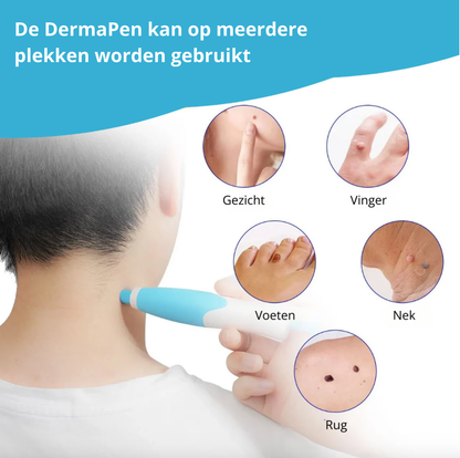 DermaPen Kit - Verwijder steelwratjes veilig en gemakkelijk thuis | 50% korting