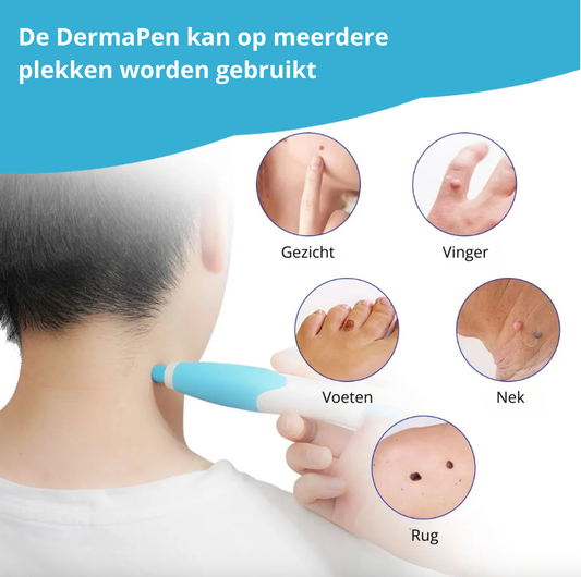 DermaPen Kit - Verwijder steelwratjes veilig en gemakkelijk thuis | 50% korting