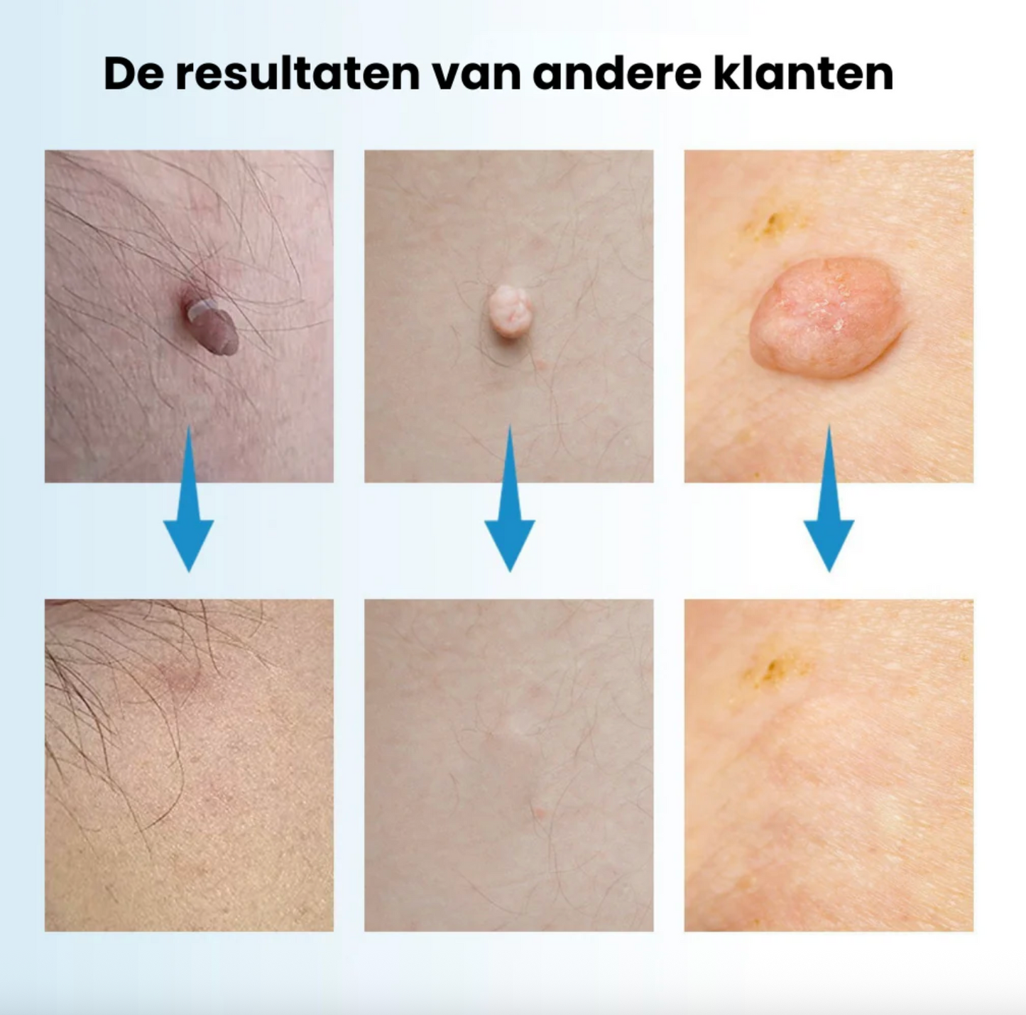 DermaPen Kit - Verwijder steelwratjes veilig en gemakkelijk thuis | 50% korting